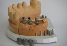 Metal Porcelain to implant