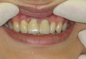 Young woman´s zircon porcelain dental work