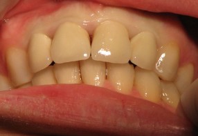 Dental Technology Middle-Aged woman´s zircon porcelain dental work