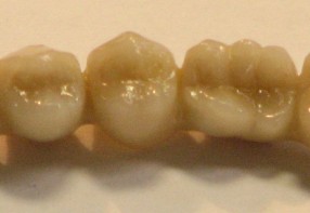 Dental zirconia ceramic bridge
