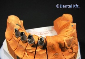 Metal porcelain dental works to implant