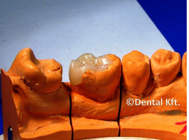 Dental Kft. - Inlay megoldások -