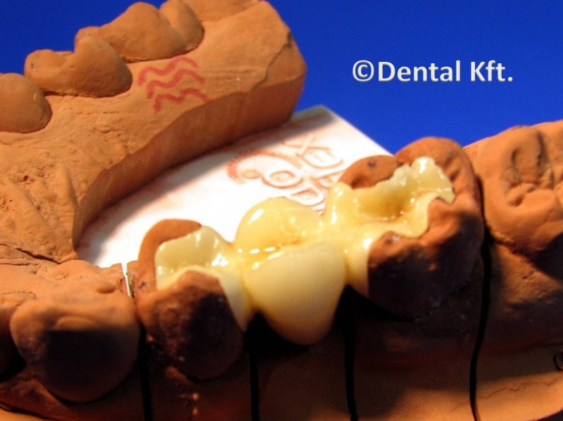 Dental Kft. - Inlay megoldások -